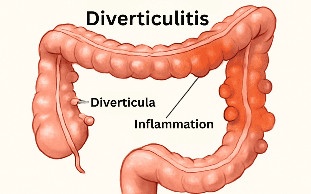 Diverticulitis: Symptoms, Causes, Treatments, and Natural Approaches