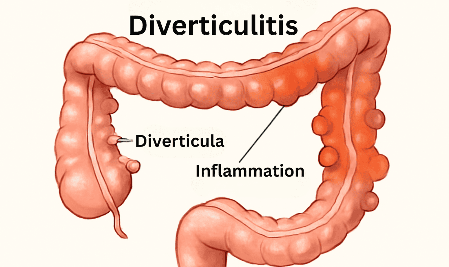 Cross-sectional medical illustration of the colon showing diverticula pockets protruding from the colon wall with surrounding inflammation highlighted