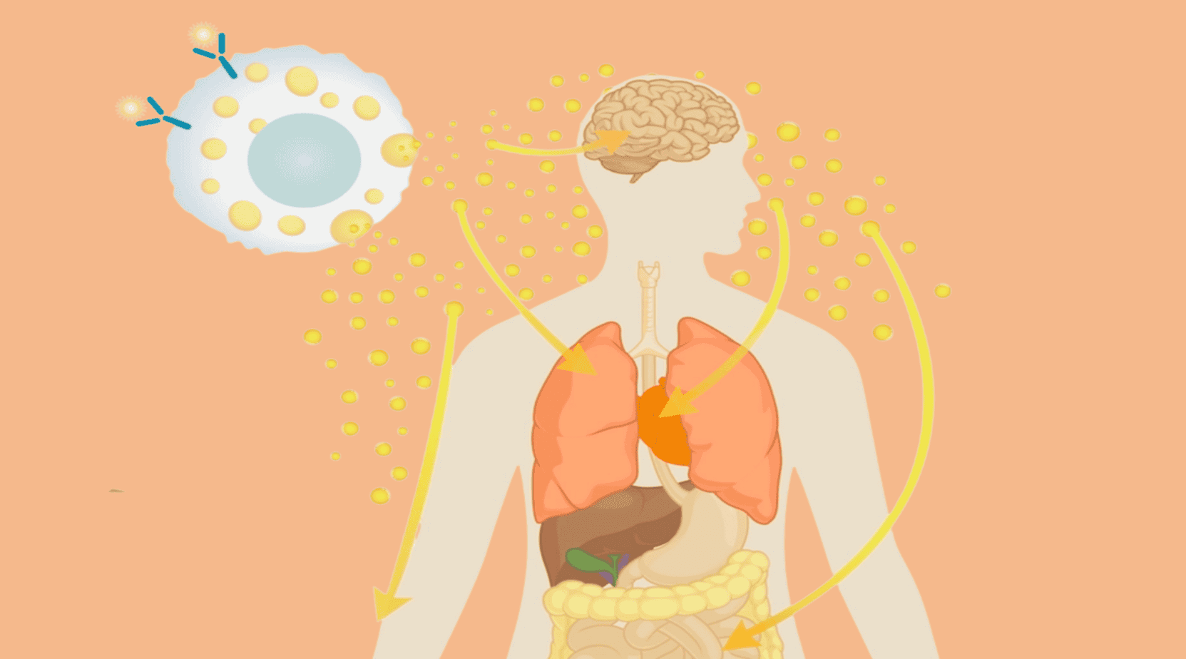 Mast cell activation syndrome (MCAS): degranulation releases histamine mediators affecting the brain, lungs, heart, liver, and gut
