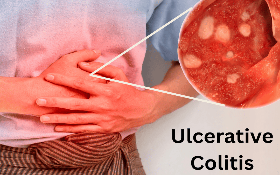 Ulcerative Colitis: Symptoms, Causes, Treatments, and Natural Approaches