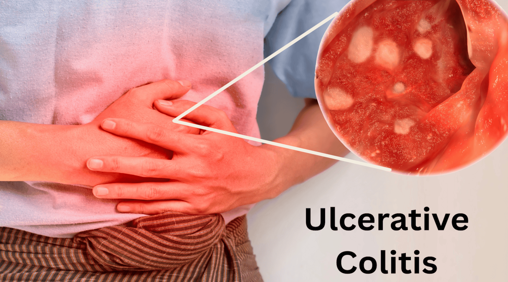 Person clutching abdomen with magnified endoscopic view of ulcerated, inflamed colon lining—illustrating ulcerative colitis