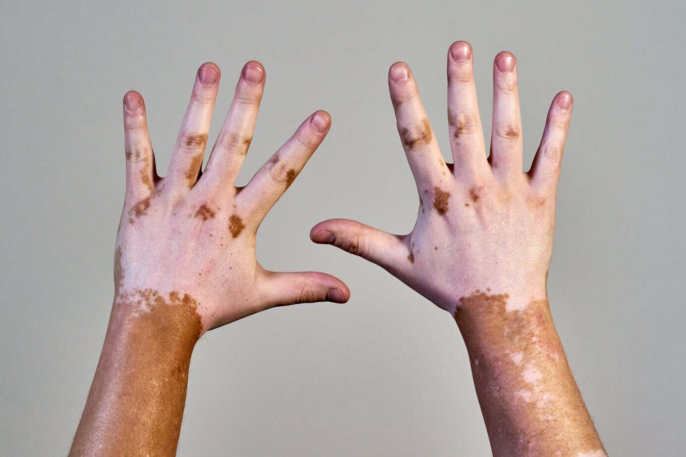Hands with vitiligo, a visible autoimmune related skin condition
